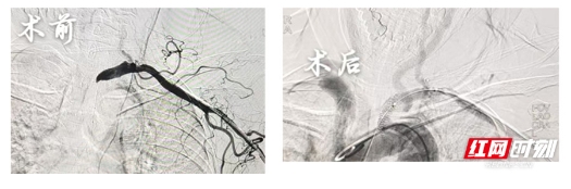 红网——卓越医疗丨永州职院附属医院成功完成一例左锁骨下动脉闭塞介入再通手术